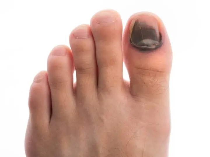 Bad toenail