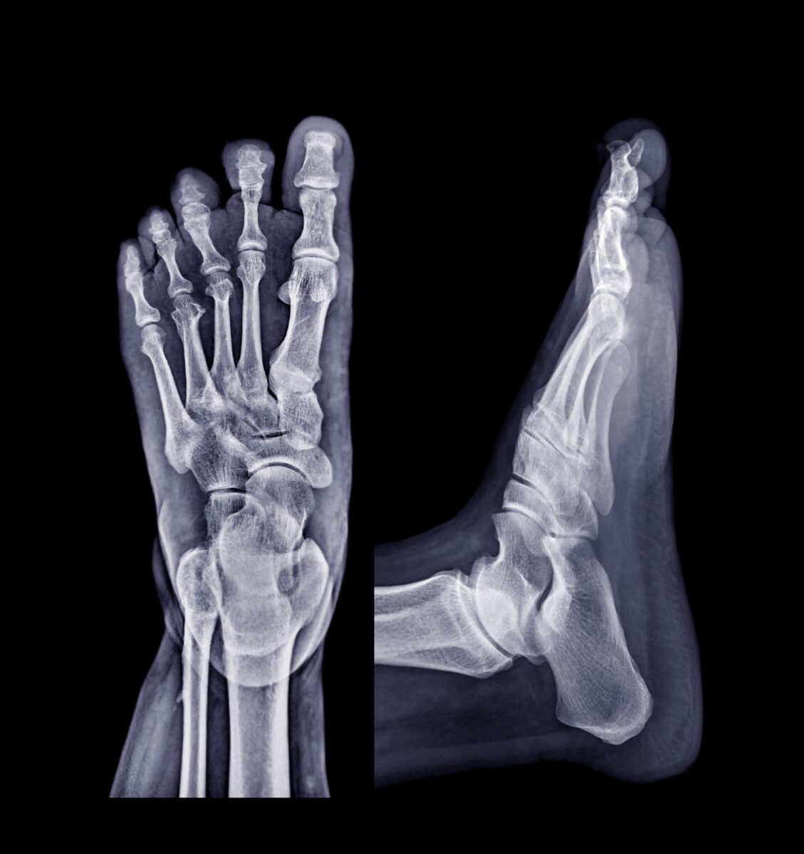 Foot x ray image AP and Lateral view isolated on black background. ○ Soccer Blade